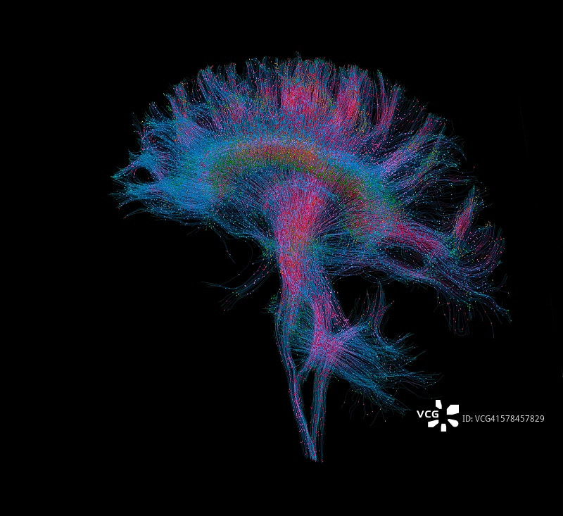 人脑的扩散MRI，也称为扩散张量成像或DTI图片素材