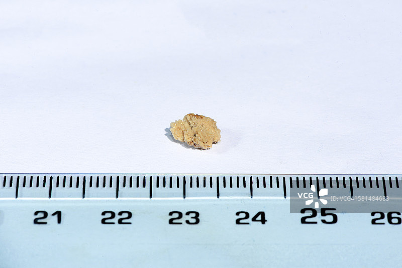 带有标尺的8毫米人类肾结石图片素材