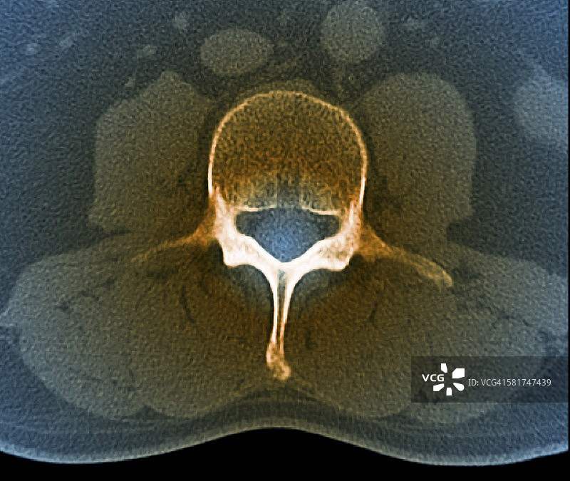腰椎CT扫描图片素材