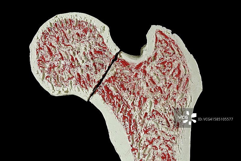 髋部骨折图片素材