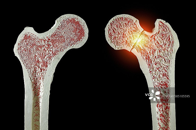 正常和骨折的髋部图片素材