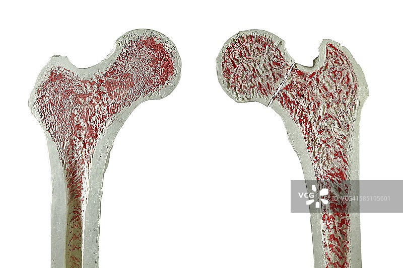 正常和骨折的髋部图片素材