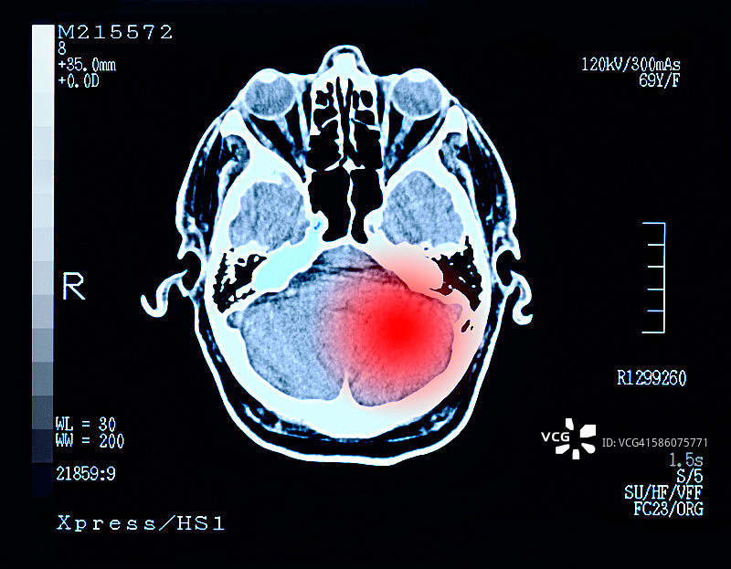 脑损伤肿瘤头痛图片素材