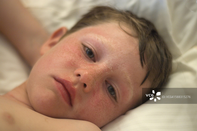 晒伤脸的男孩图片素材