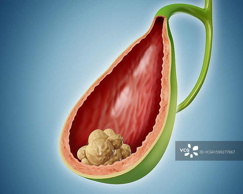 胆结石，图示图片素材