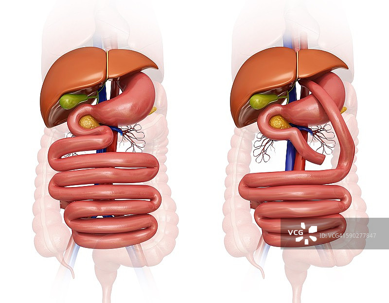 胃旁路手术示意图图片素材