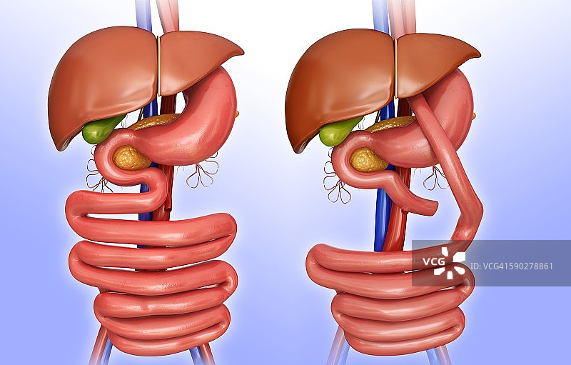 胃旁路手术示意图图片素材