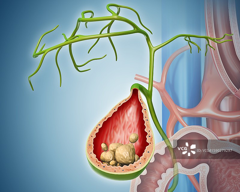 胆结石，图示图片素材