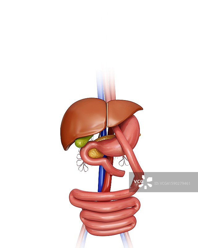 胃旁路手术示意图图片素材