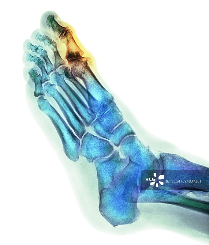 退行性足部畸形X光片图片素材