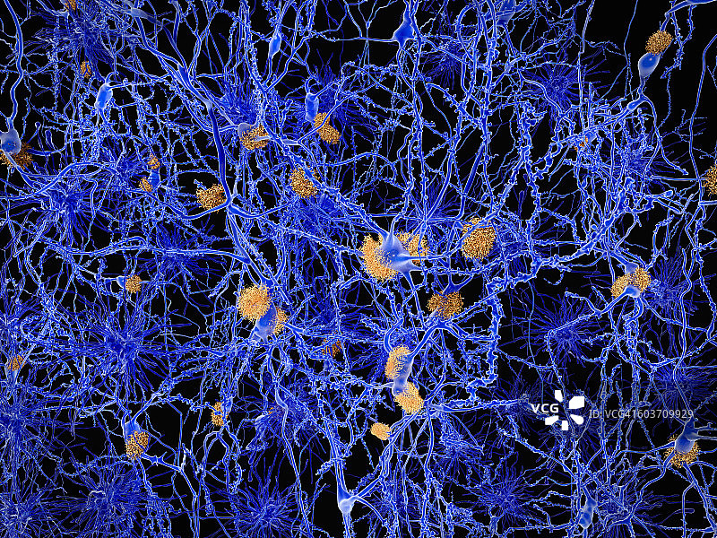 阿尔茨海默病插图图片素材