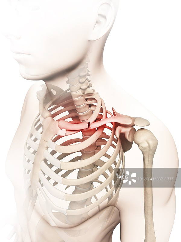 锁骨骨折插画图片素材