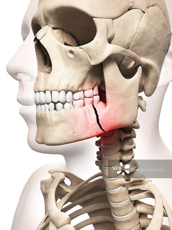 下颌骨骨折插图图片素材