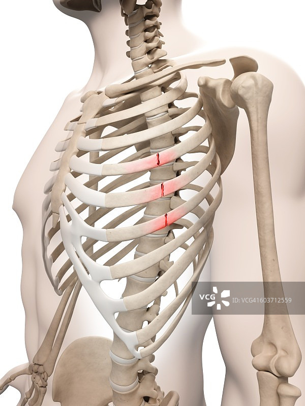 肋骨骨折插画图片素材