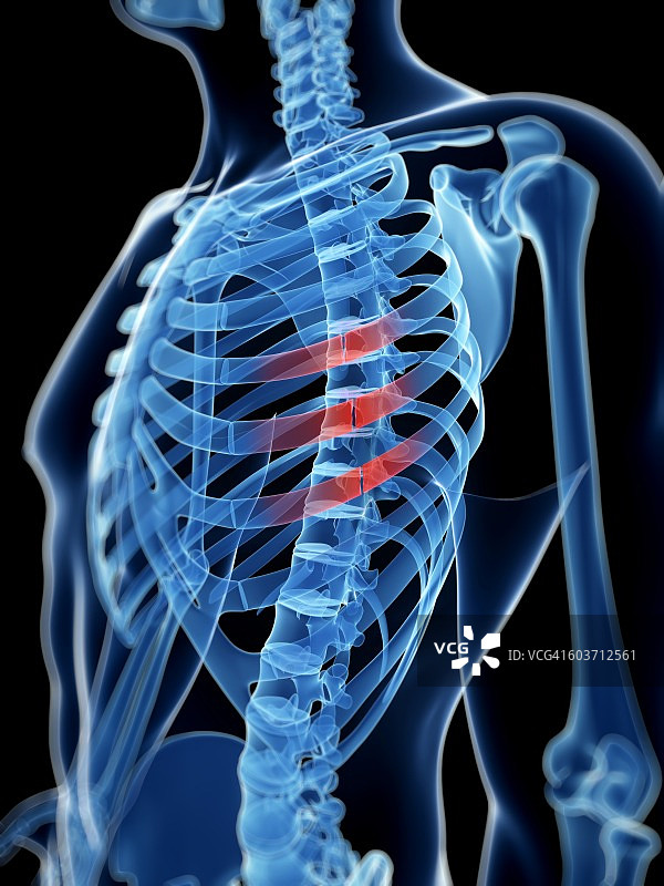 肋骨骨折插画图片素材