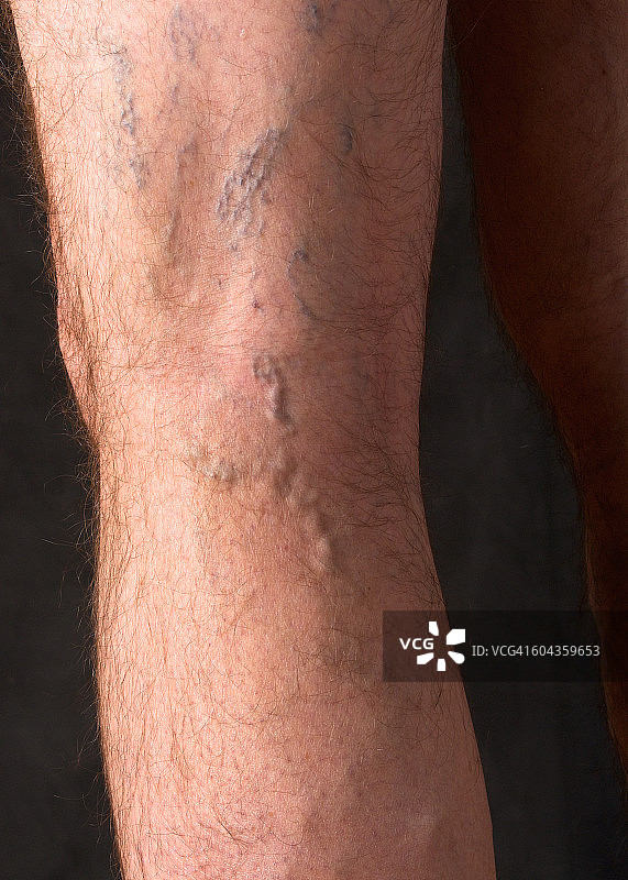 男人腿部的静脉曲张图片素材