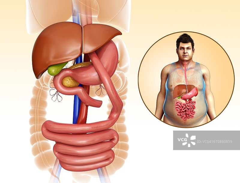 胃旁路手术示意图图片素材