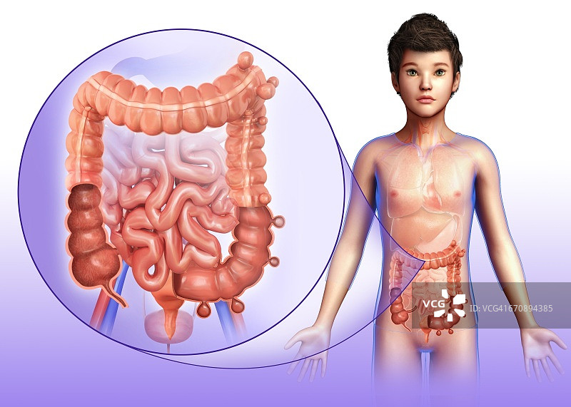 憩室病，图示图片素材