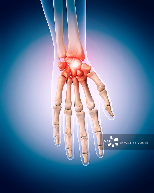 手腕疼痛示意图图片素材