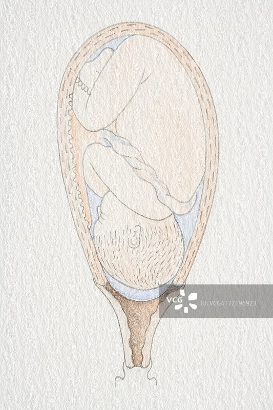 羊膜囊完整的倒置胎儿在肿胀的子宫内，头部从扩张的宫颈口推出图片素材