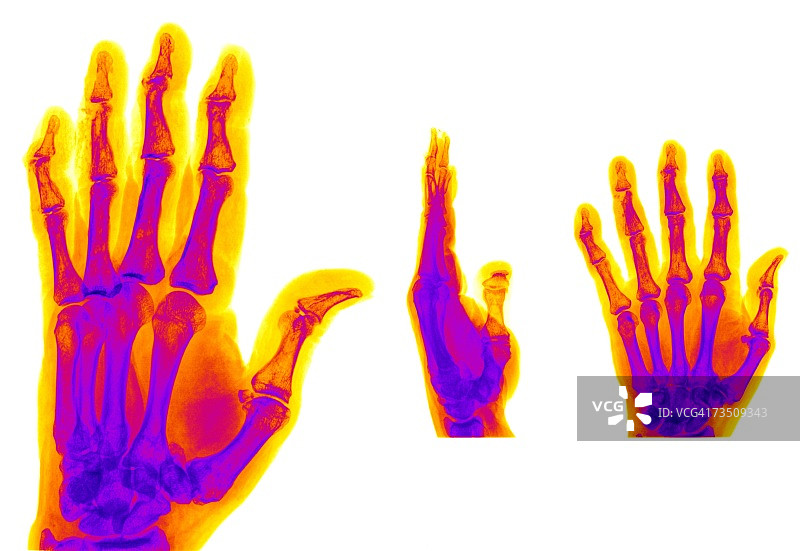 包含手指骨折的三种不同视角的X光片图片素材
