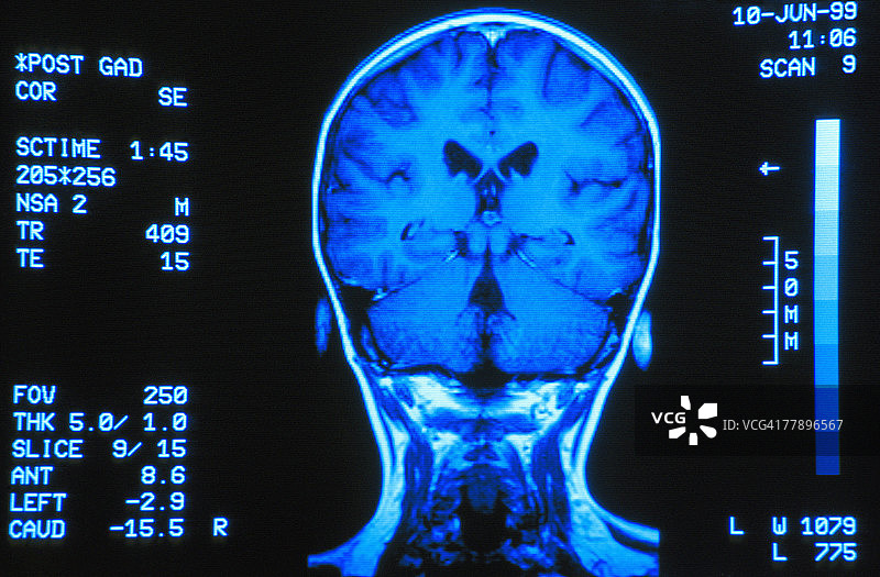 大脑后部的陀螺扫描图片素材