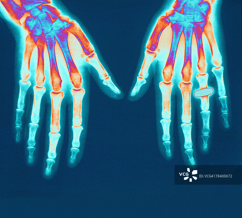 手部X光片图片素材
