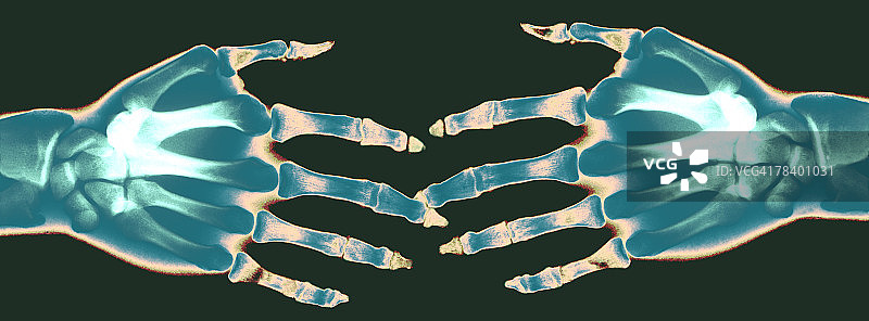 手部X光照片图片素材