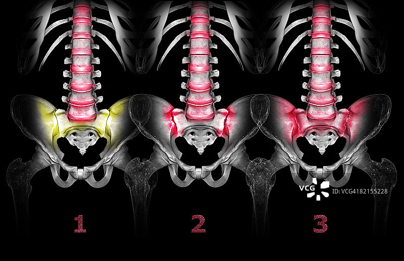 盆骨关节疼痛图片素材