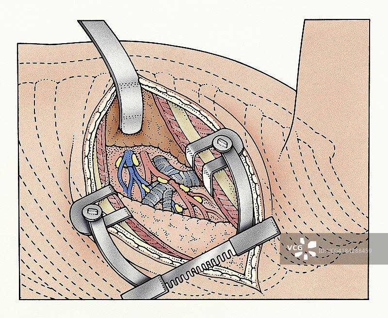 肋间切口扩张器暴露人体肺部和血管插画图片素材