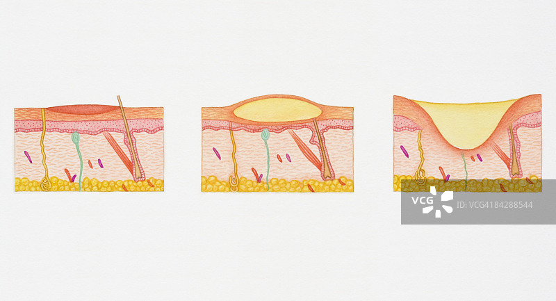 人体皮肤三个横截面中表皮和真皮的起泡二级烧伤插图图片素材