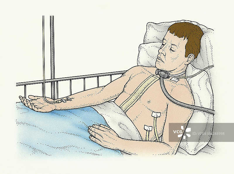 肺移植术后：连接呼吸机、胸管和静脉滴注的卧床男性患者插画图片素材