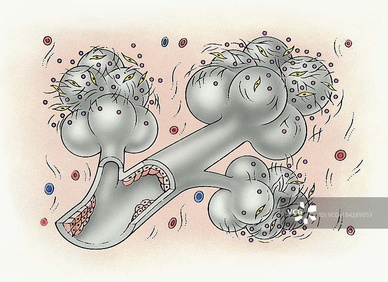 覆盖着无机颗粒、成纤维细胞和生长因子，阻塞内壁的支气管和肺泡插画图片素材