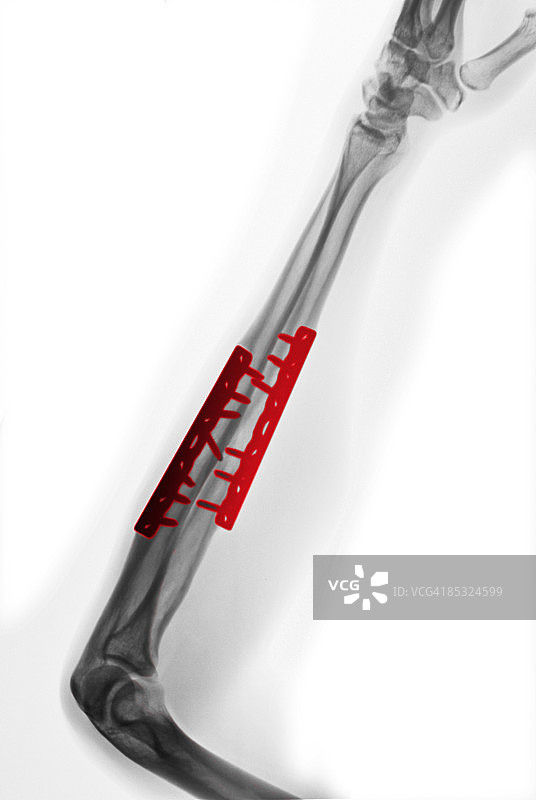 手术修复的前臂骨折X光片图片素材