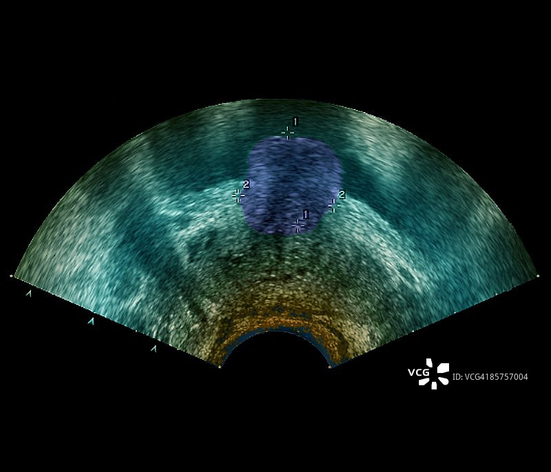 前列腺肿瘤图片素材