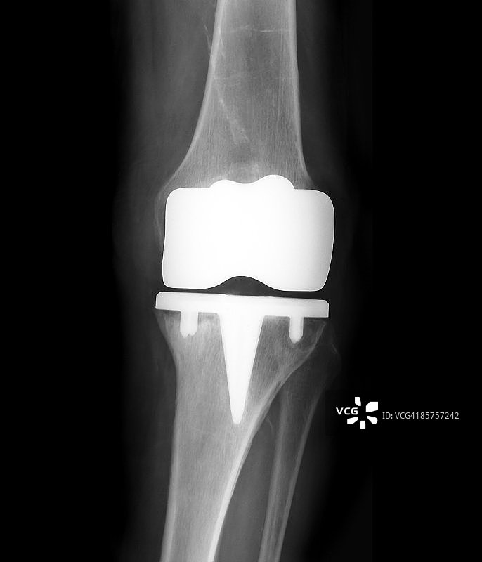 假肢膝关节（黑白照片）图片素材