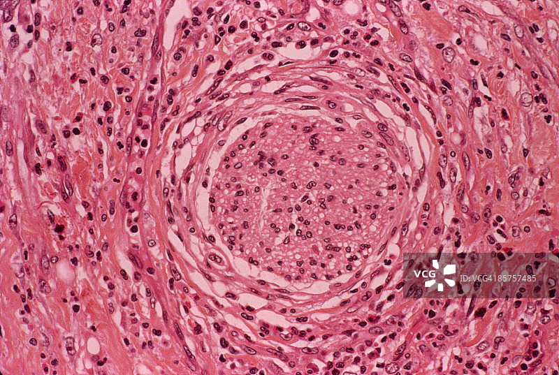 胃溃疡图片素材