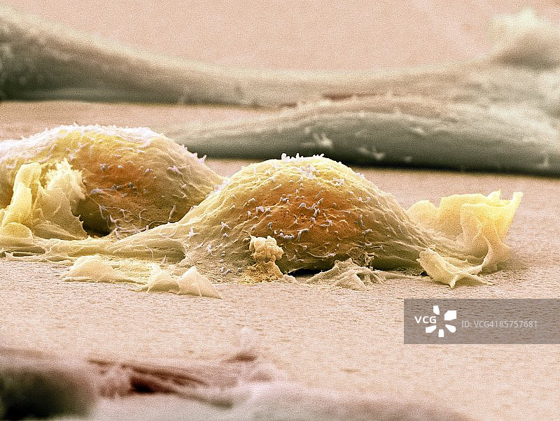 肉瘤细胞图片素材