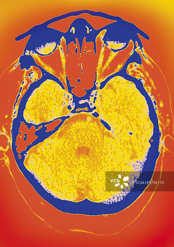 正常大脑彩色轴向计算机断层扫描图片素材