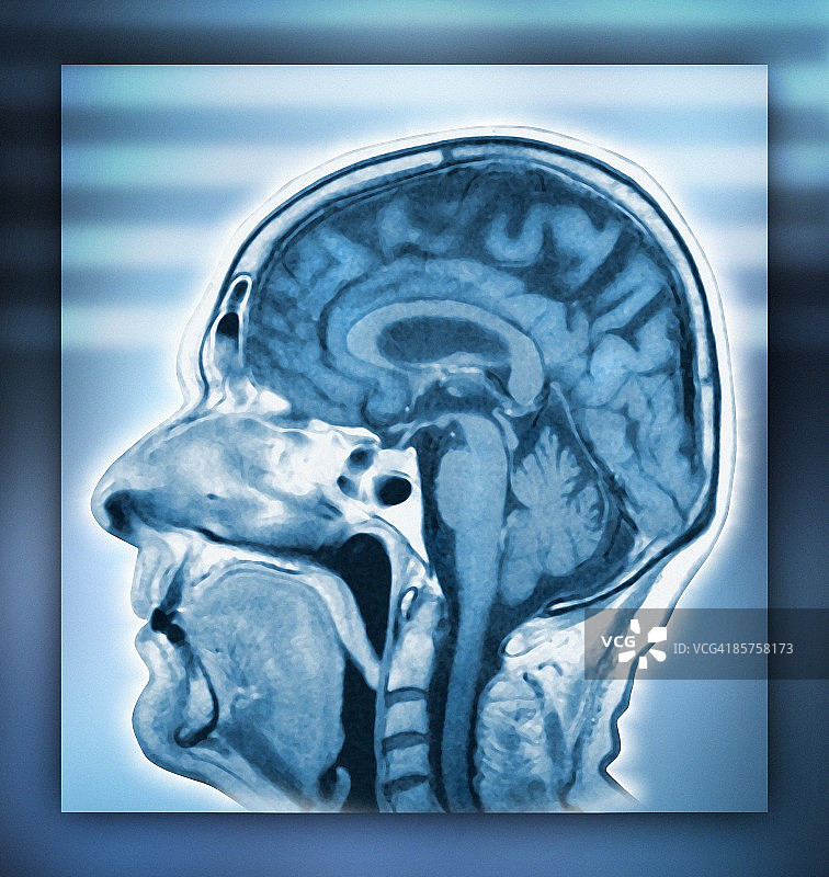 人脑核磁共振扫描图片素材