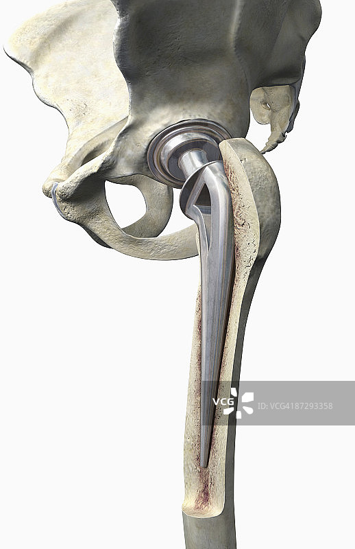 髋关节置换图片素材