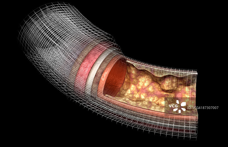 动脉壁图片素材