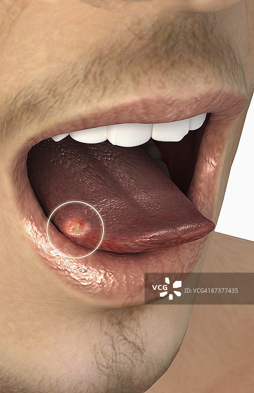 口腔溃疡图片素材