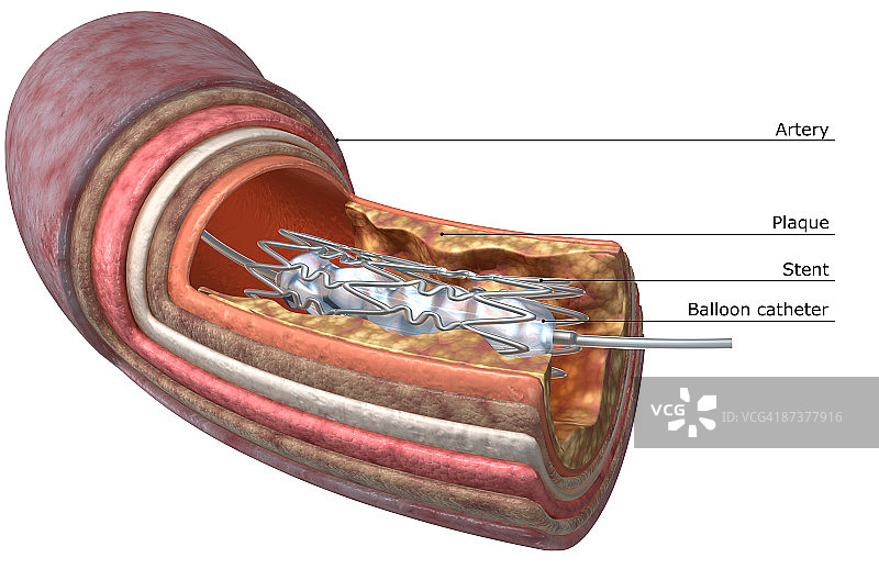 血管成形术图片素材