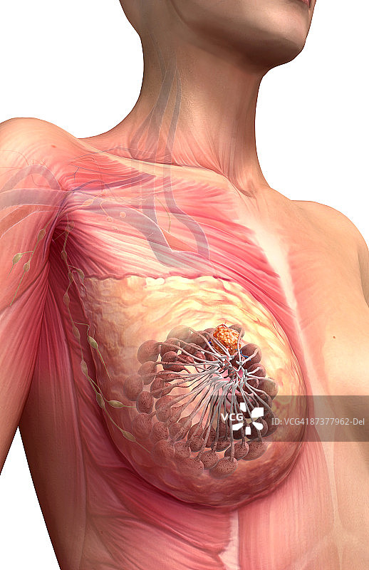 乳腺癌图片素材