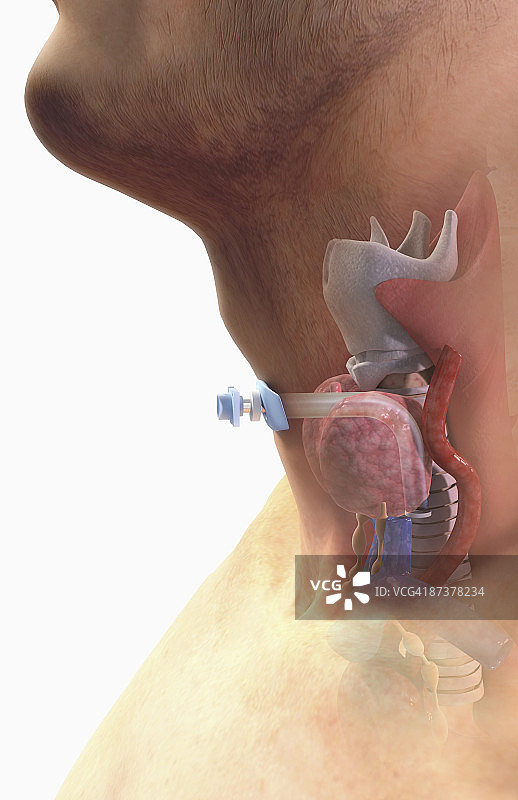 气管切开术图片素材