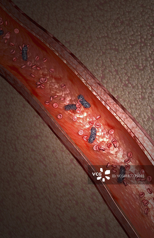 细菌性血液感染图片素材