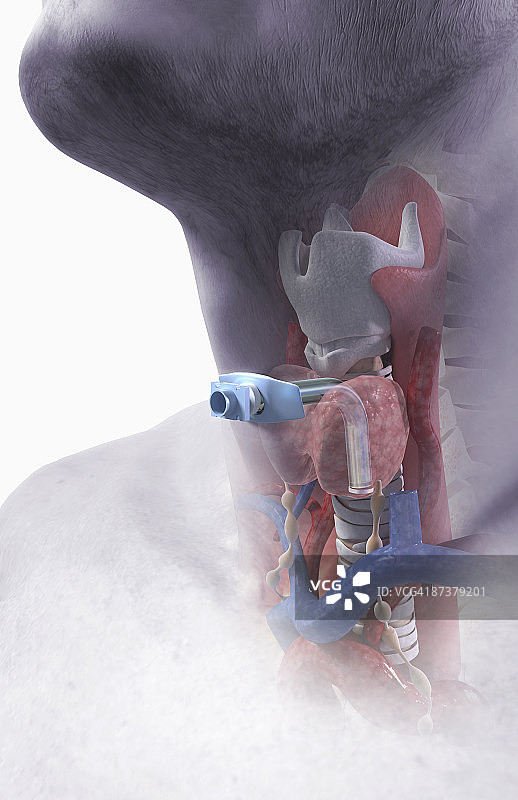 气管切开术图片素材