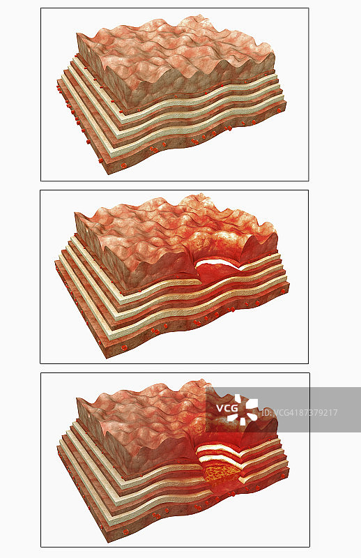 胃溃疡图片素材