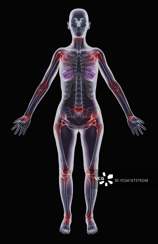 脊椎炎图片素材